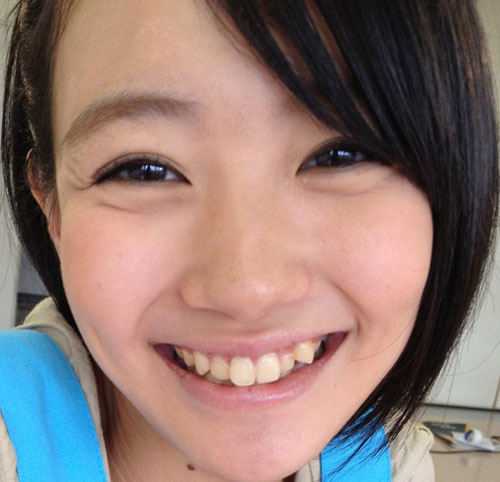 荻野可鈴さんの前歯の画像（八重歯・ビーバー歯） 僕の審美歯科ガイド｜前歯の差し歯治療で後悔しないための情報源