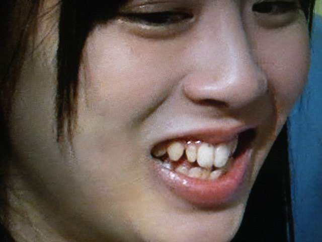 Hkt48の坂口理子さんの前歯や歯並び 矮小歯解消 僕の審美歯科ガイド 前歯の差し歯治療で後悔しないための情報源