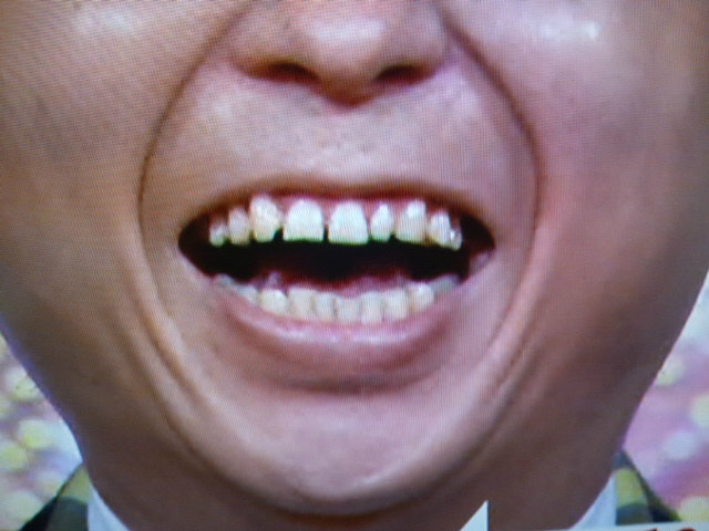 有吉弘行の前歯