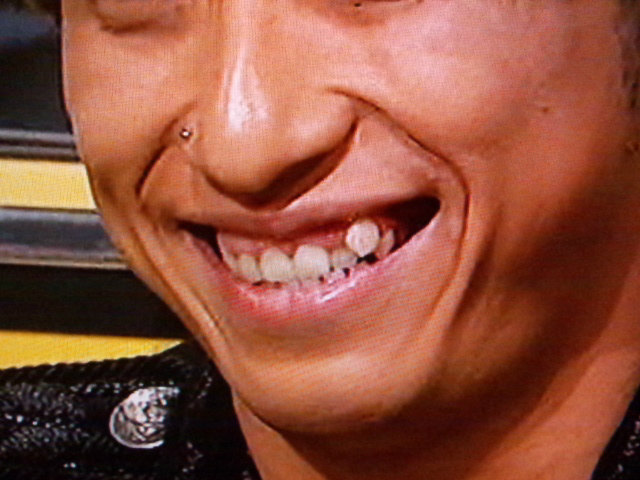 Kenji03さんの前歯の画像 八重歯 ガミースマイル 僕の審美歯科ガイド 前歯の差し歯治療で後悔しないための情報源