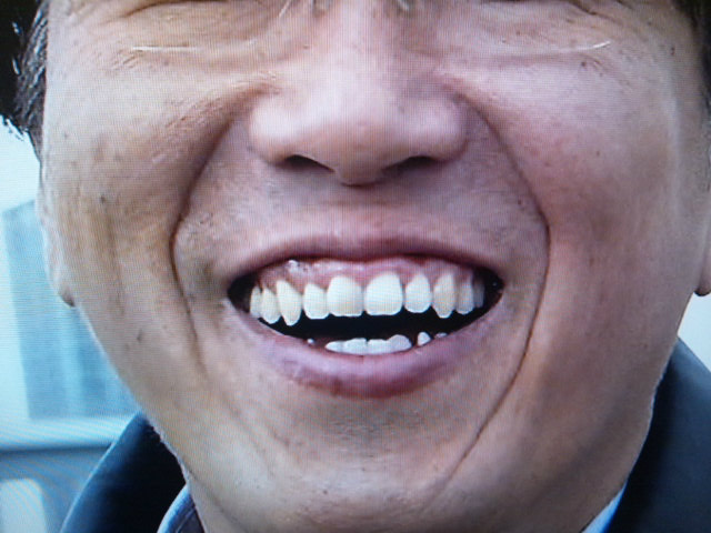 石橋貴明さんの前歯と歯茎を批評 僕の審美歯科ガイド 前歯の差し歯