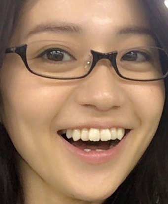 大島優子さんの前歯や歯並びを評論 歯列矯正 僕の審美歯科ガイド 前歯の差し歯治療で後悔しないための情報源