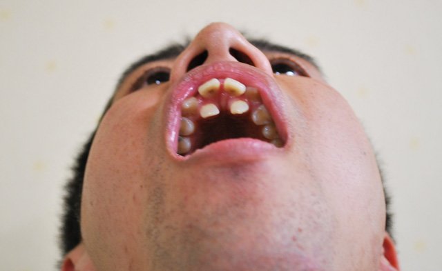 ウエストランドの井口浩之さんの二重歯列を評論 歯列矯正スタート 僕の審美歯科ガイド 前歯の差し歯治療で後悔しないための情報源