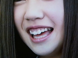 SKE48の北川綾巴さんの前歯の画像 - 僕の審美歯科ガイド|前歯の差し歯治療で後悔しないための情報源