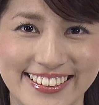 永島優美アナウンサーの前歯や歯並び - 僕の審美歯科ガイド｜前歯の差し歯治療で後悔しないための情報源