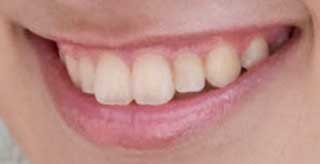 アッキーナ　前歯の写真