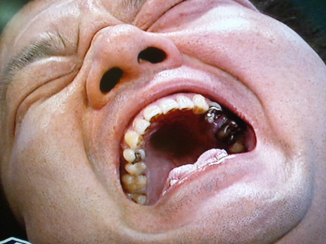 カガリP　歯