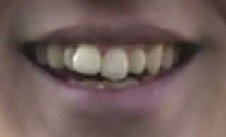 藤浪の前歯