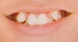 八乙女　八重歯