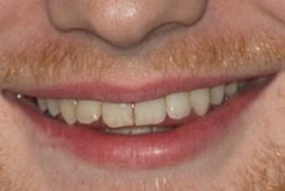Ed Sheeran　歯