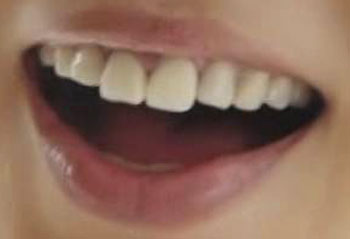 松たか子さんの前歯の写真 ガミーフェイス 僕の審美歯科ガイド 前歯の差し歯治療で後悔しないための情報源