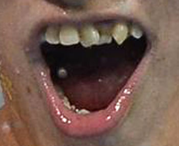 孫楊　前歯の写真
