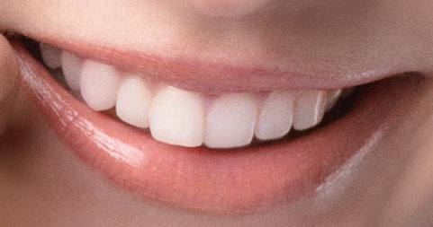 加賀美セイラ　前歯の写真