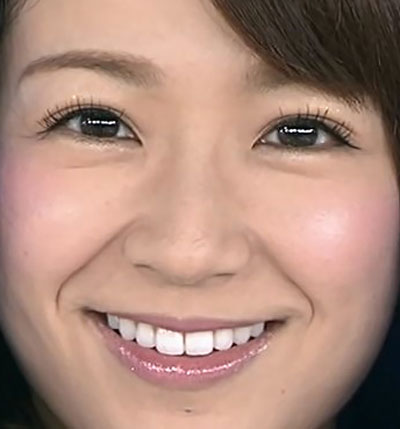 長野美郷さんの前歯の画像 - 僕の審美歯科ガイド｜前歯の差し歯治療で後悔しないための情報源