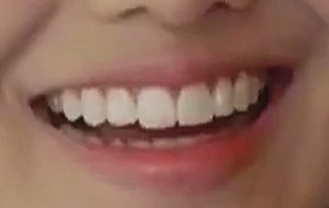 スヨンの前歯の写真