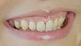 花澤香菜の前歯の写真