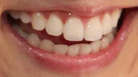 小林麻耶　前歯の写真