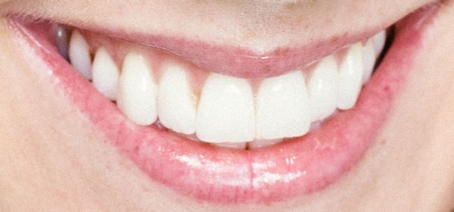 シャーロット・ケイト・フォックス　前歯の写真