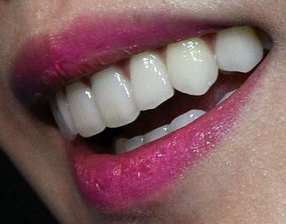BoA　前歯の写真