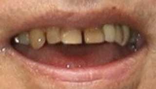 池上彰　前歯の写真