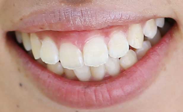 笠りつ子　前歯の写真