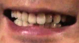 田中哲司　前歯の写真