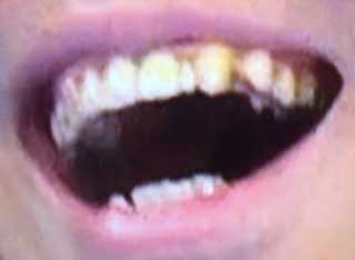 鈴木拓　前歯の写真