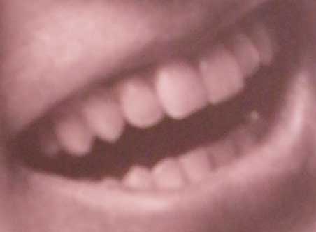 稲葉浩志　前歯の写真