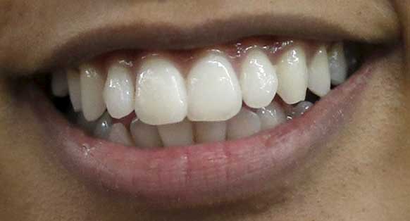 宮本エリアナ　前歯の写真