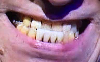 斉藤洋介の前歯の写真