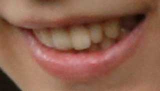 佳子様　前歯の写真