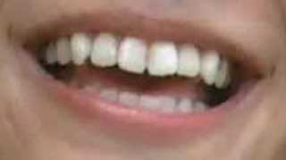 上田亜樹　前歯の写真