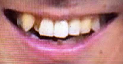 アキラ100%　前歯の写真