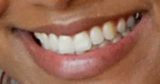 クリスタル・ケイ　前歯の画像