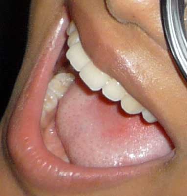 クリスタル・ケイ　前歯の写真