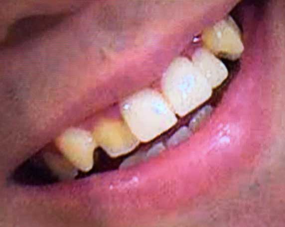 川添奨太　前歯の写真