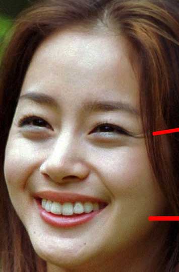 Kim Tae-hee　前歯の審美歯科治療