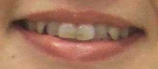 西山喜久恵　前歯の写真