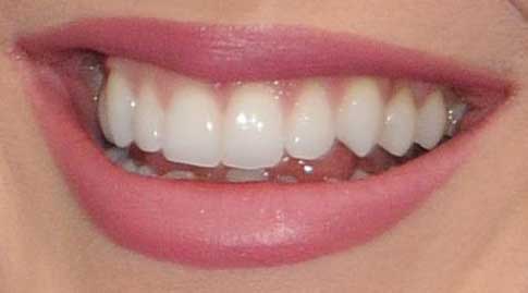 Katy Perry　前歯の写真