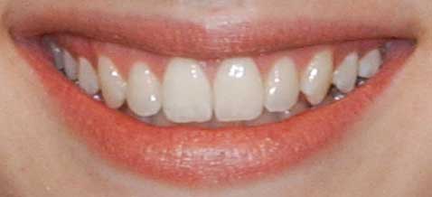 エマ・ロバーツ　前歯の写真