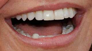 キャメロン・ディアス　前歯の写真