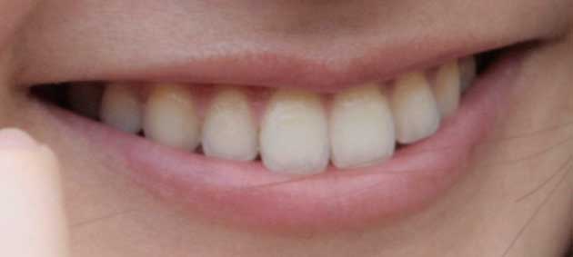 坂井香　前歯の写真