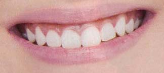 E-girls　前歯の写真
