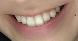 金子栞　前歯の写真