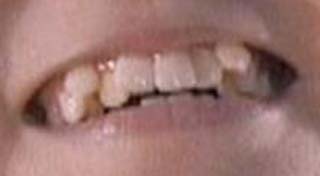 SU-METAL　歯並びの写真