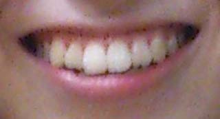 青木瑠璃子　前歯の写真