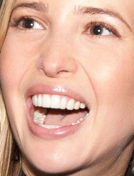 Ivanka Trump teeth