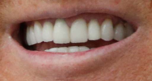 Donald Trump tooth