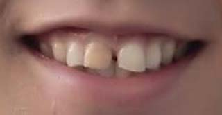 天達武史　前歯の写真