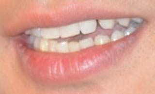 妻夫木聡　前歯の写真